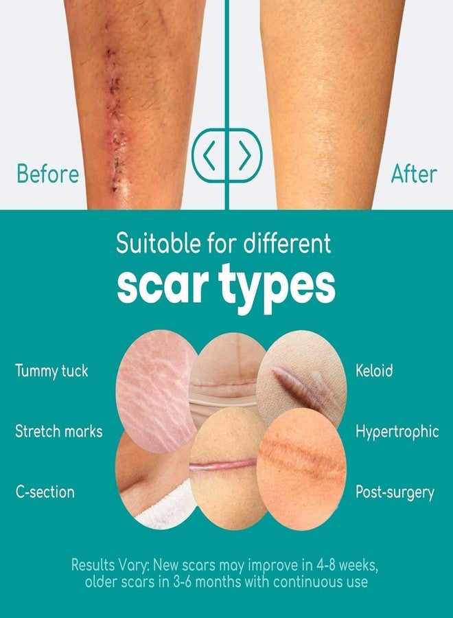 Medi Grade Silicone Scar Sheets with German Medical Grade Silicone – 80" Reusable Scar Tape for C-Section, Keloid, Burn, Acne and Surgical Scars – Silicone Scar Removal Strips - Hygienic Storage Case - Image 2